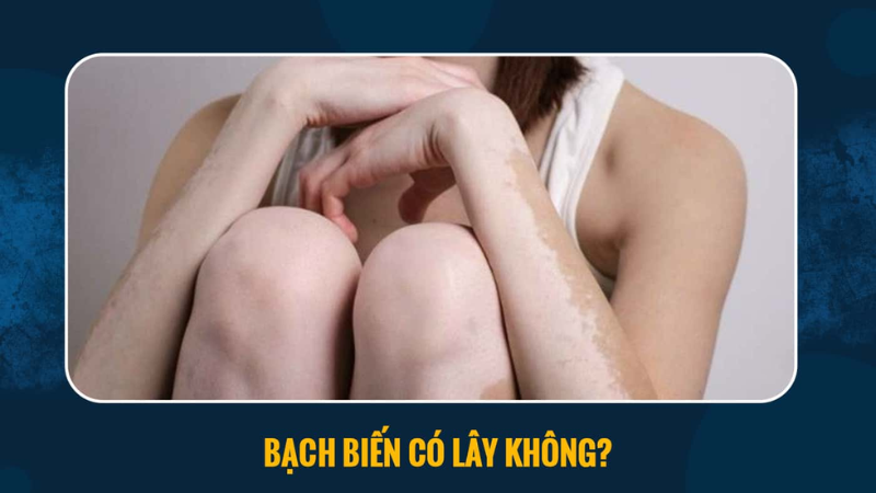 bệnh bạch biến có lây không