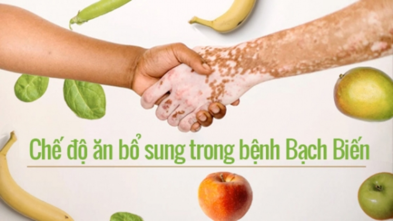 bệnh bạch biến kiêng an gì