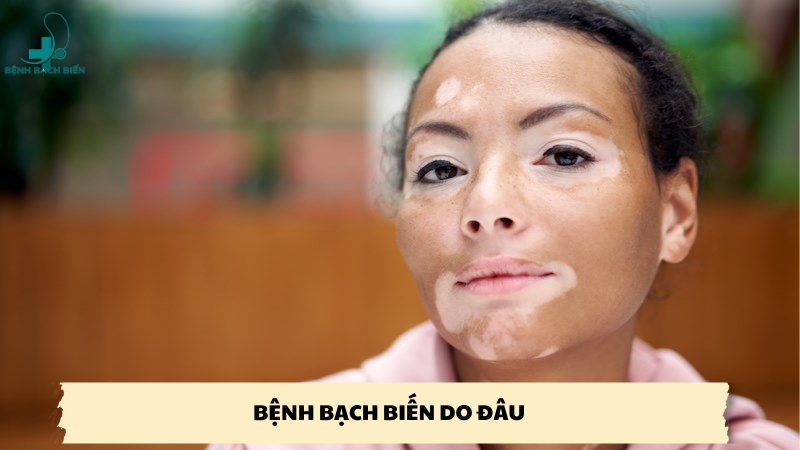 bệnh bạch biến do đâu