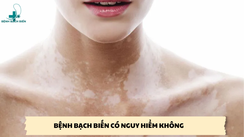 bệnh bạch biến có nguy hiểm không