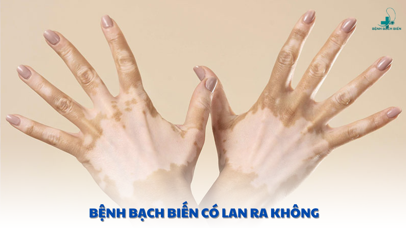 bệnh bạch biến có lan ra không