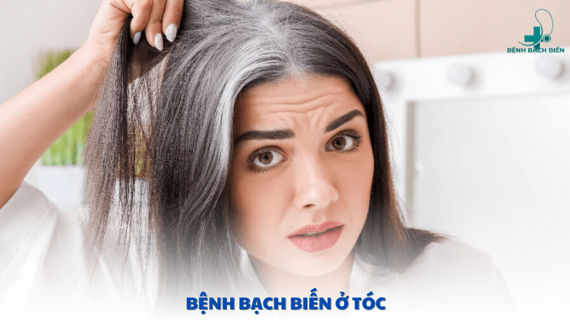 bệnh bạch biến ở tóc